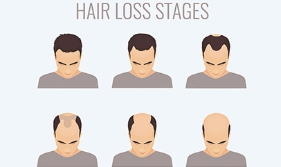 Chosing An Experienced Hair Transplant Surgeon Is Key!