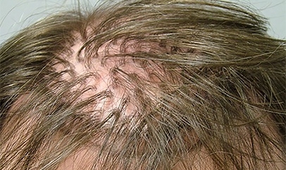 Hair Transplant Methods And Revisions