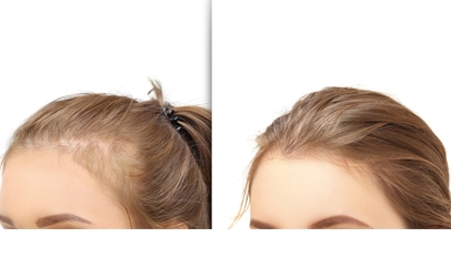 How to Achieve Thicker Hair Permanently with Hair Transplant Surgery in Newport Beach and ...