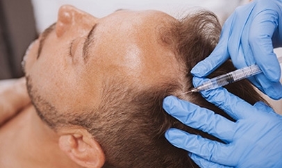 Is PRP Hair Loss Treatment in Newport Beach and Beverly Hills Effective for Hair Regrowth?