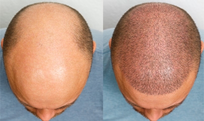 Signs That Hair Transplant Is Right For You