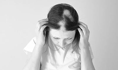 What is Alopecia?