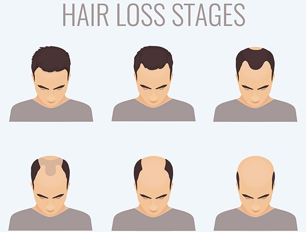 Experienced hair transplant surgery