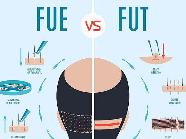 FUE and FUT Hair Transplant