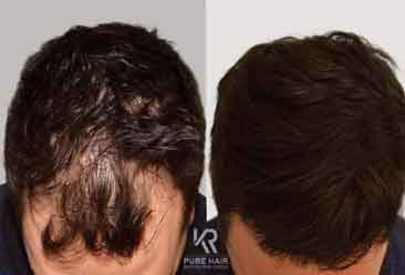 Hair Transplant10