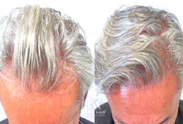 Hair Transplant11