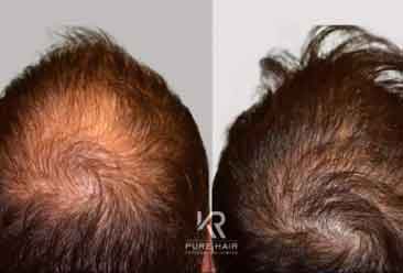 Hair Transplant12