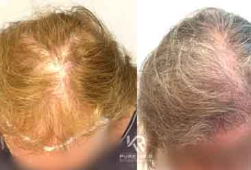 Hair Transplant14