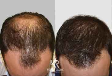 Hair Transplant3