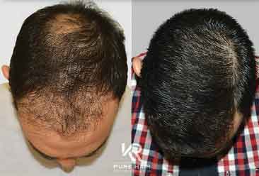 Hair Transplant4