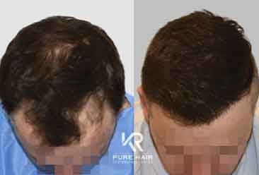 Hair Transplant5