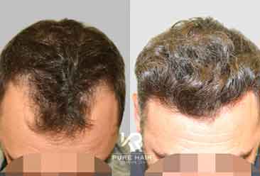Hair Transplant2