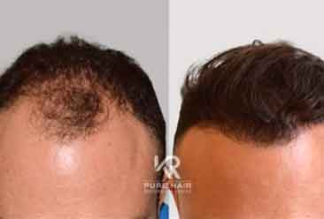 Hair Transplant7