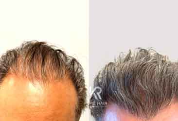 Hair Transplant8