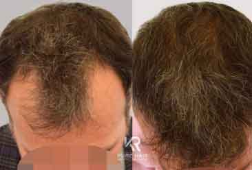 Hair Transplant9