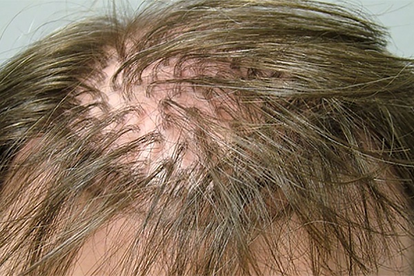 Hair transplant technique