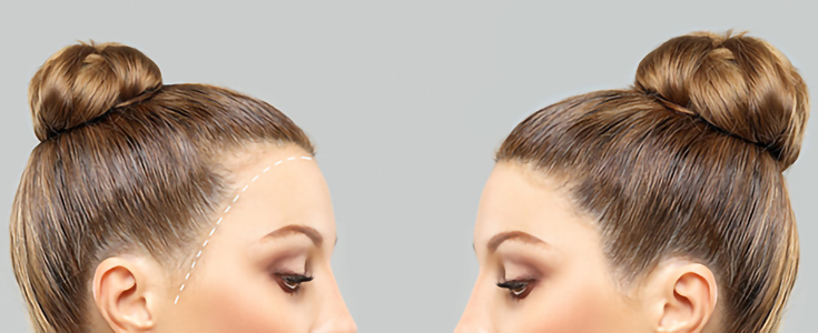 FUE vs. FUT: Which Hair Transplant Surgery in Newport Beach Is Right for You?