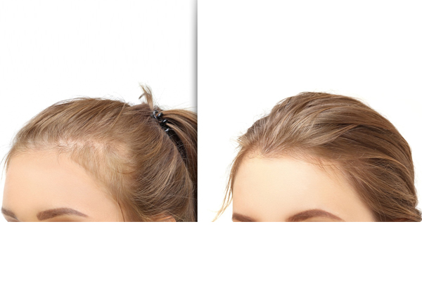 How to Achieve Thicker Hair Permanently with Hair Transplant Surgery in Newport Beach and Beverly Hills