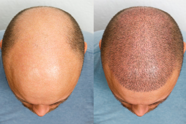 Signs That Hair Transplant Is Right For You